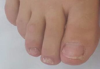 Promicil cured advanced nail fungus