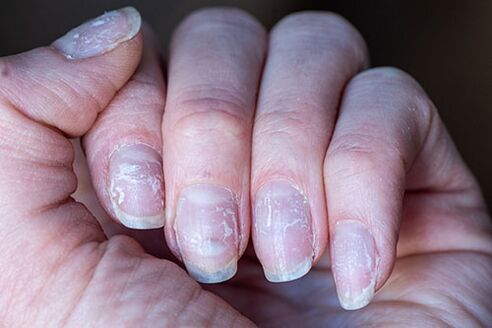 fungus on the nails