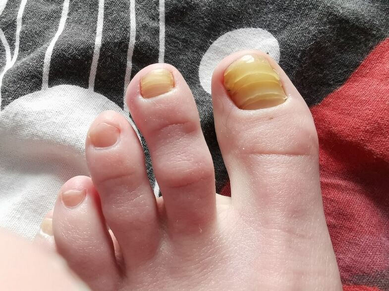 nail fungus