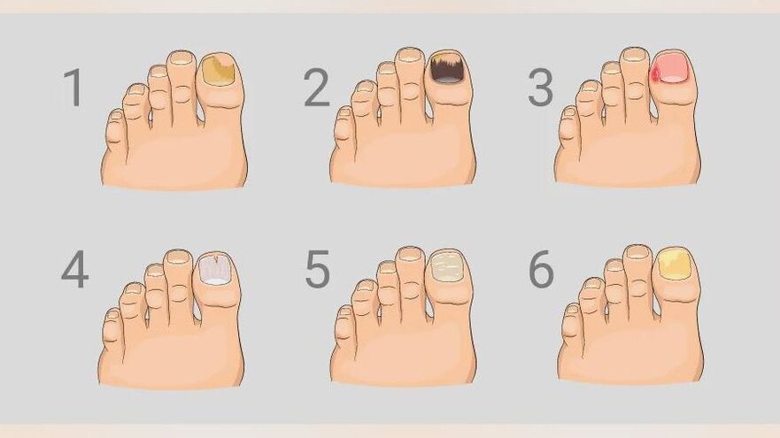 main signs of athlete's foot