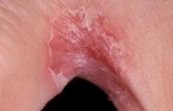 Mushroom on the legs between the fingers