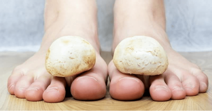 Rapid treatment of mushrooms on the legs at home