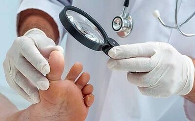 How to get rid of nail fungus