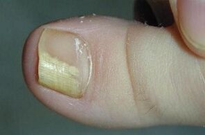 Causes of fungal appearance on the thumb of the foot