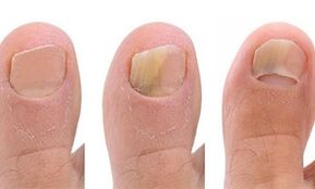Stages of fungal development on the thumb of the foot