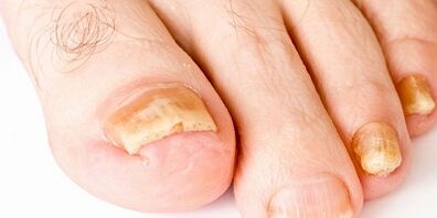 How and how to cure nail fungus