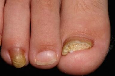The mycosis of the nails of the legs