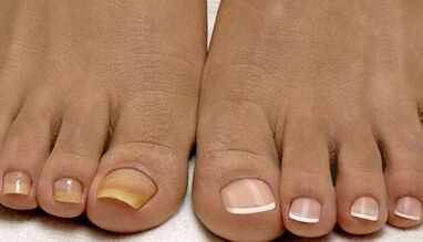 The reasons for the appearance of the fungus on the nails