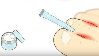 How to treat fungal toes