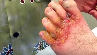Symptoms of mushrooms on the toes