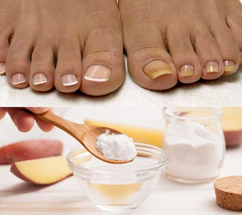 Baking soda to treat nail fungus
