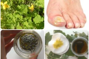 folk remedy against nail fungus