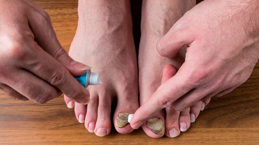 Applying an antifungal cream to the nail to treat nail fungus